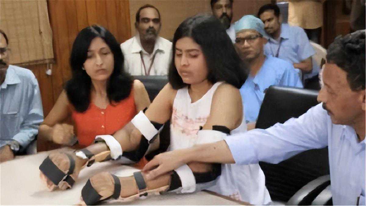 因车祸失去双臂的印度花季少女，移植他人手臂后，皮肤慢慢变白